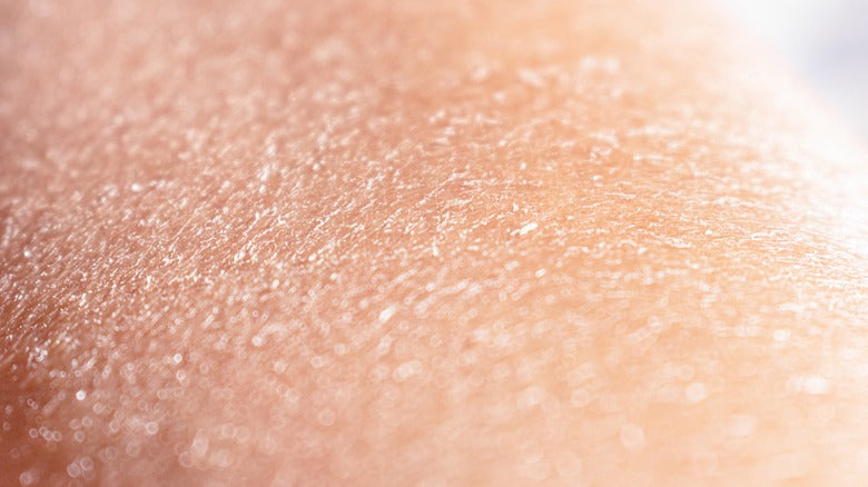 Help, I’ve Got Dry Flakey Skin! What Do I Do?